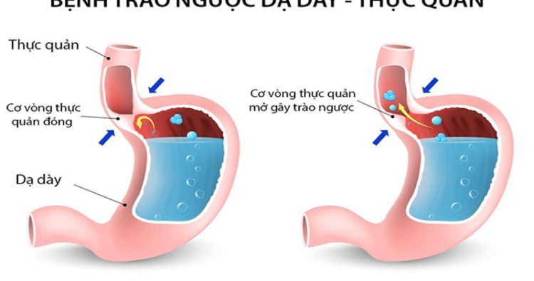 Trào ngược dạ dày thực quản