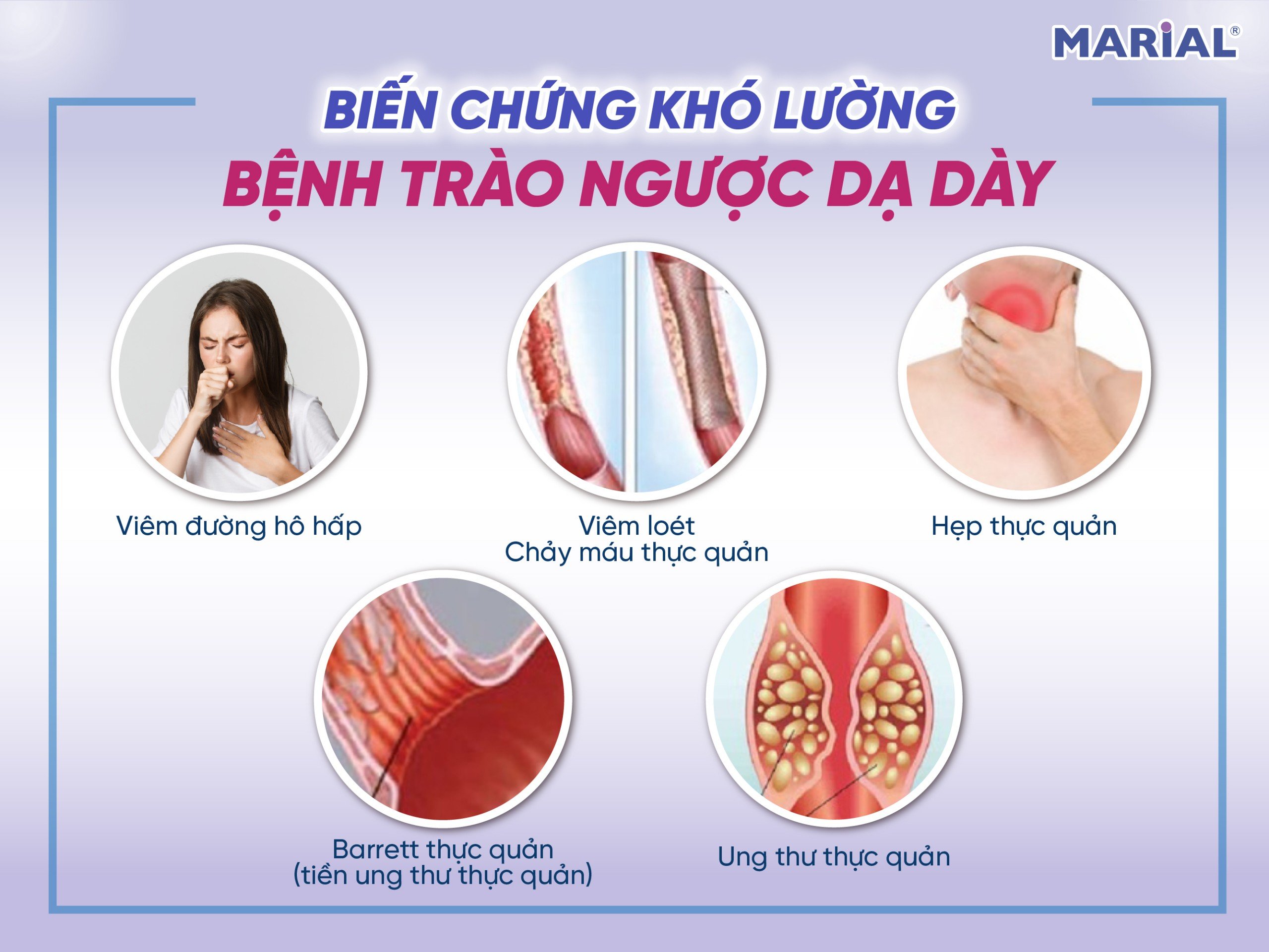 Biến chứng trào ngược dạ dày thực quản