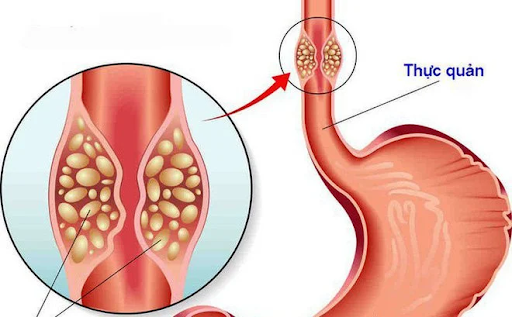 Ung thư thực quản là biến chứng nghiêm trọng nhất của trào ngược dạ dày thực quản